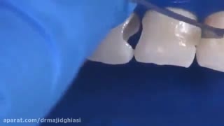 پوسیدگی دندان-دکترمجیدقیاسی دندانپزشک زیبایی مشهد