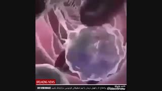 بیماریی پسوریازیس