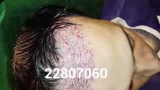 کاشت مو - دکتر ابدالی - 22807060