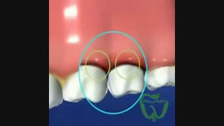 تمیز کردن پلاک دندان ها