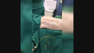 فیلم لیپوماتیک پشت