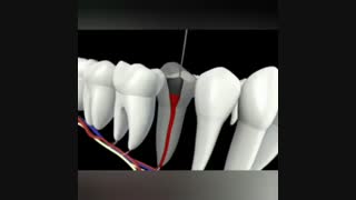 فیلم مراحل انجام درمان ریشه دندان