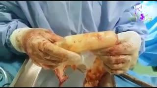 فیلم جراحی واژینوپلاستی