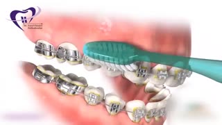 رعایت بهداشت در طول ارتودنسی | دکتر فیروزی