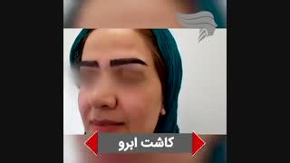 کاشت ابرو 1