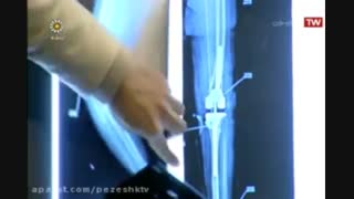 ⭐ چه افرادی باید برای تعویض مفصل زانو اقدام کنند؟ | دکتر یاسر نژادی