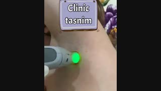 لیزر موهای زائد زیر بغل