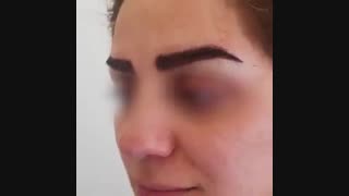 به روزترین روش کاشت ابرو