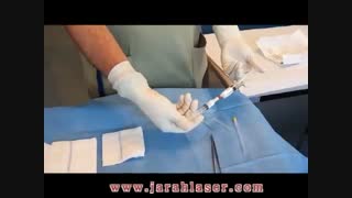 درمان بواسیر یا هموروئید با اسکلروتراپی