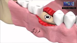 کاشت ایمپلنت به صورت انیمیشن(حتما ببینید)