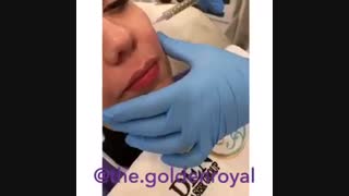 جوانسازی پوست PRP درمان جای جوش