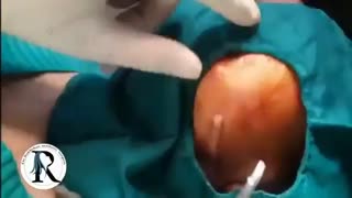 تخلیه ژل پاژ
