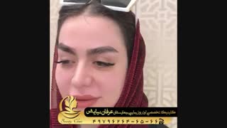 رضایت از کاشت ابرو