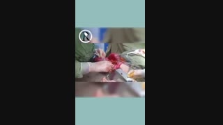 عمل ولولوس معده