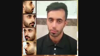 سه هفته بعد از جراحی بینی