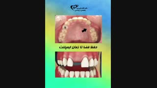 حفظ فضا برای ایمپلنت | دکتر فیروزی