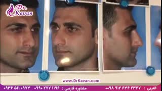 رفع گرفتگی بینی به همراه عمل زیبایی توسط دکتر کاوان