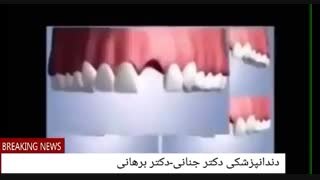 ایمپلنت دندان