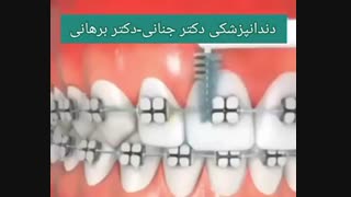 بهداشت دهان و دندان طی درمان های ارتودنسی