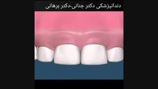 جراحی افزایش طول دندان