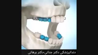 نحوه استفاده از دستگاه های متحرک ارتودنسی