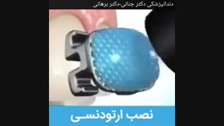 نصب براکت های ارتودنسی
