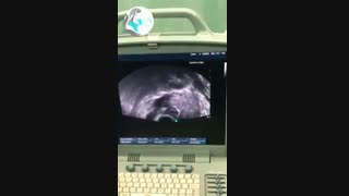 بارداری خارج رحمی در لاین سزارین قبلی