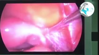عمل لاپاراسکوپی در رحم تک شاخ با سابقه نازایی