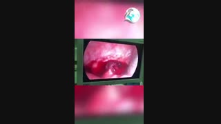 عمل لاپاراسکوپی و سالپنگوستومی