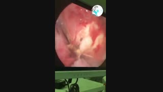 عمل هیستروسکوپی برداشتن سپتوم رحمی در خانمی با سقط های مکرر