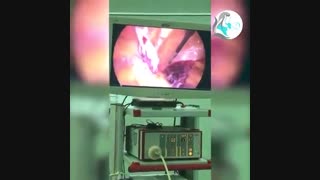 لاپاراسکوپی کیست تخمدان