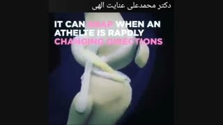 علائم بالینی پارگی رباط صلیبی قدامی