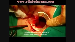 هموروئیدکتومی چیست؟