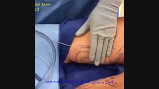 لیپوماتیک و تخلیه چربی ها از بدن