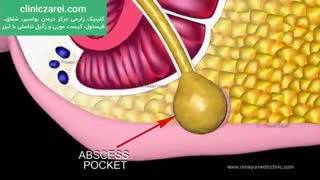 درمان فیستول مقعدی با لیزر بدون عمل جراحی در کلینیک زارعی