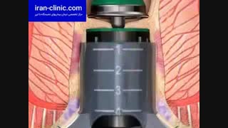 درمان هموروئید یا درمان بواسیر بدون عمل جراحی در کمتر از یک ساعت در ایران کلینیک