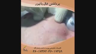 فیلم برداشتن خال با لیزر