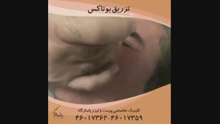 تزریق بوتاکس در مردان