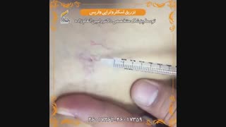 درمان قطعی واریس یا روش ساده