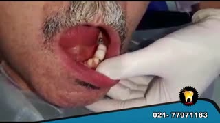 ایمپلنت کل دهان یا فول موس