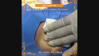 فیلم لیفت صورت با نخ در ایران