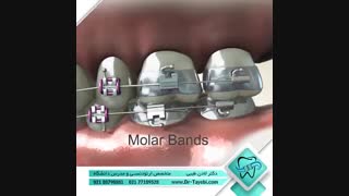 قسمت های مختلف ارتودنسی ثابت | دکتر طیبی