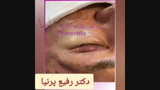 فیلم بلفاروپلاستی یا جراحی پلک اندودنتیکس