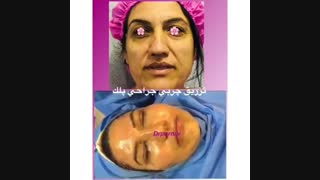بلفاروپلاستی و تزریق چربی لیفت صورت