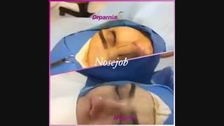 عمل بینی توسط دکتر رفیع پرنیا فوق تخصص جراحی پلاستیک ترمیم ونیر