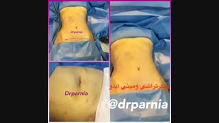 پیکرتراشی و مینی ابدومینوپلاستی آکنه