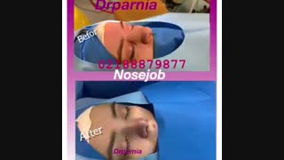 جراحی بینی توسط دکتر رفیع پرنیا دندان پیش