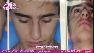 عمل زیبایی بینی مردانه توسط دکتر کاوان