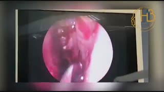 تخلیه چرک از سینوس فکی با جراحی آندوسکوپی سینوس