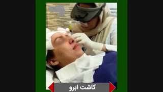 روش جدید کاشت ابرو